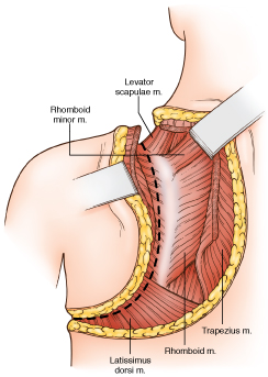 Arm Amput_66-5
